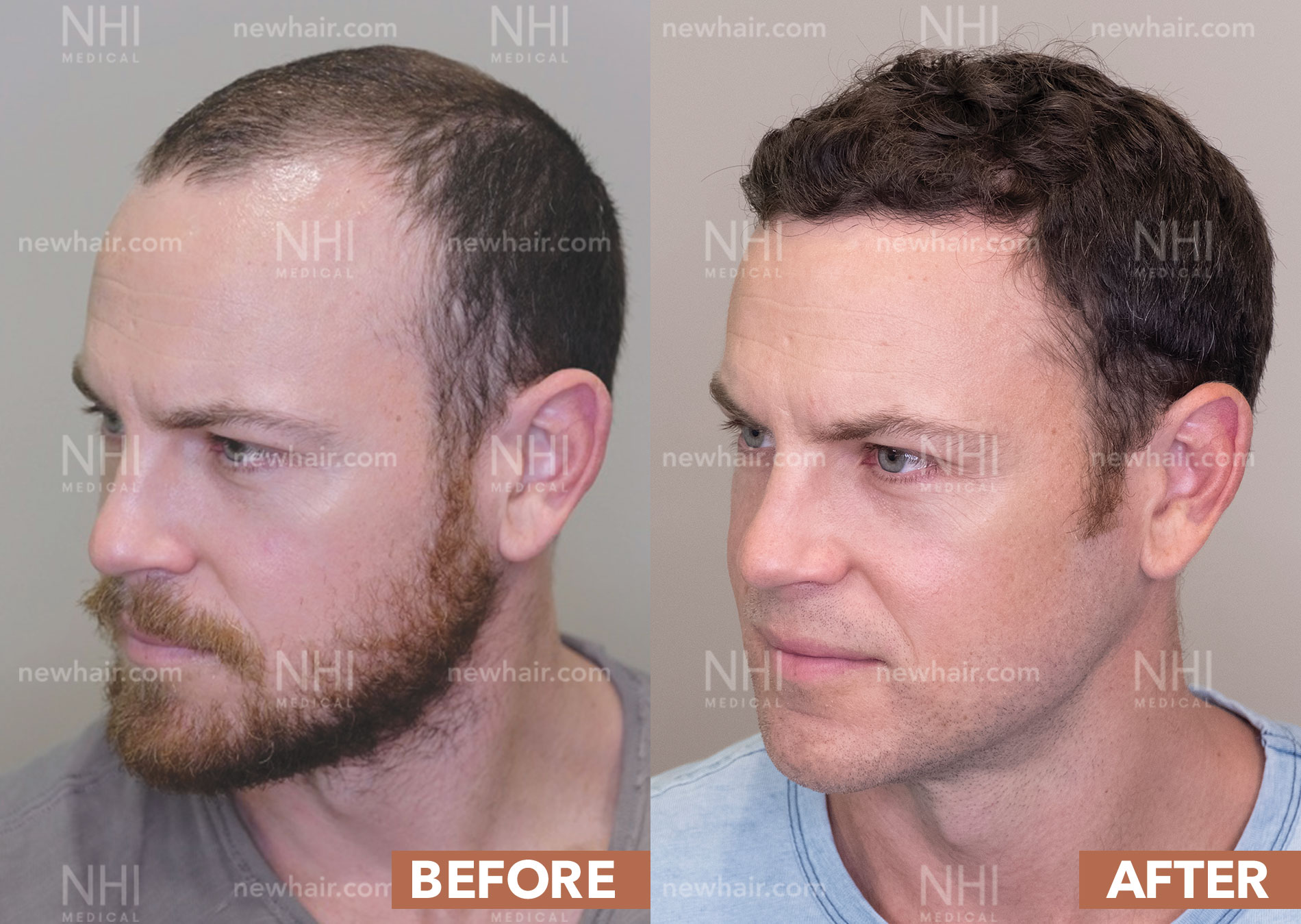 Before After Hair Transplants For Men