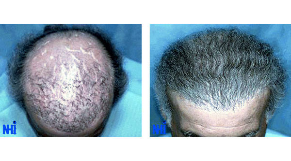 How Do You Reverse Or Fix A Bad Hair Transplant Plug? (Before After Photos)  – WRassman,. BaldingBlog