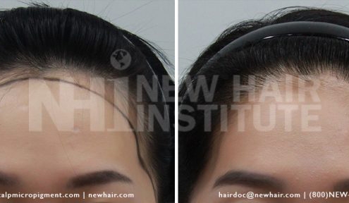 Hairline Lowering Forehead Reduction Results