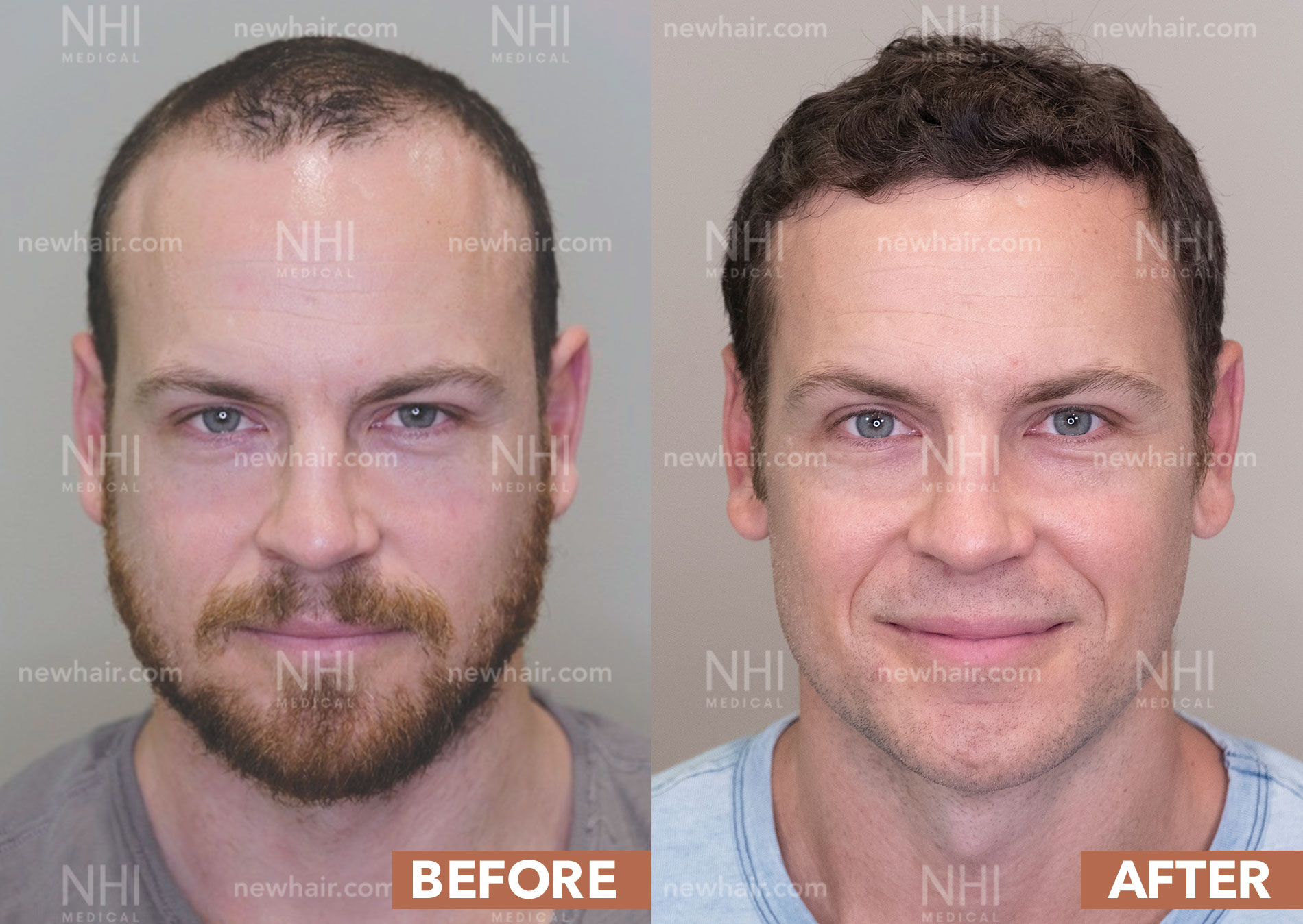 The Most Advanced Hair Transplant Method for Hair Loss (FUE)