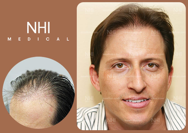 Moderate Hair Loss NHI Medical Top Hair Restoration Doctors In FUE 