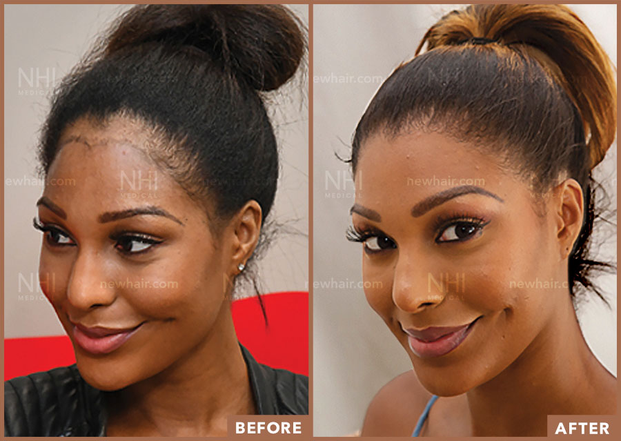Before and After Image Result for Female Hairline Lowering