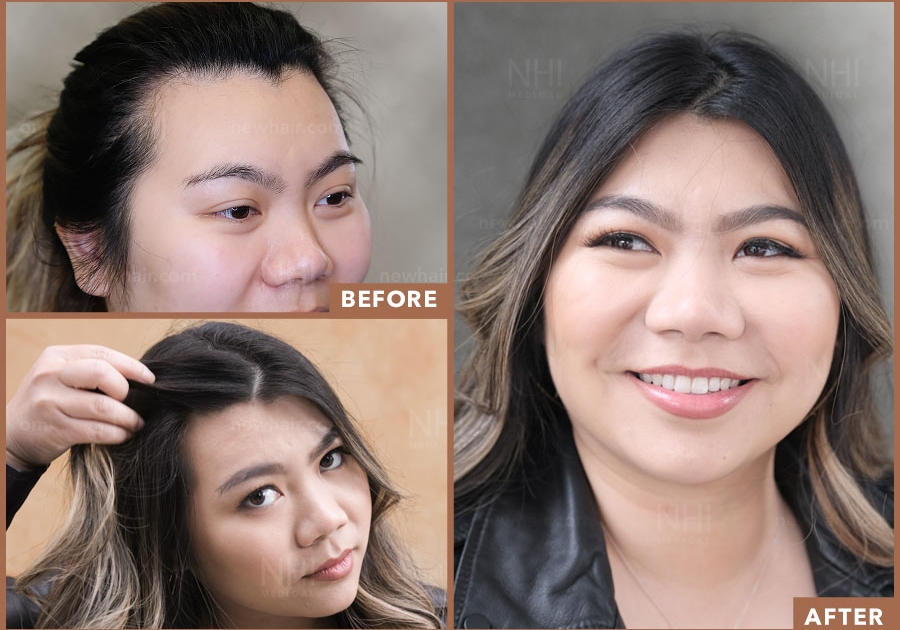 Before and After Comparison of Hairline Lowering Surgery