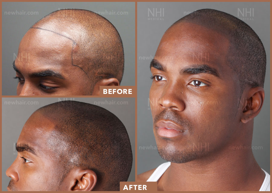 The advanced medical hair tattoo to hide hair loss (SMP)