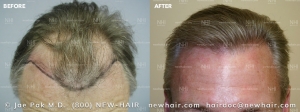 Hair Transplant Before and After (3/114)